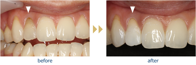 Before and After: Actual Patient (Internal Bleaching Auckland)