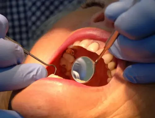 Scientists ‘excited’ by gel to repair tooth enamel